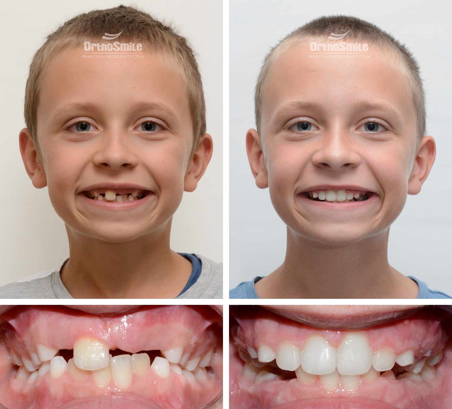 Powodem konsultacji oraz leczenia małego Pacjenta była obecność dodatkowego siekacza bocznego. W związku z tym przemieszczeniu uległ zawiązek siekacza przyśrodkowego. Przez to proces jego wyrzynania był uniemożliwiony (tzw. ząb zatrzymany).
Dodatkowy ząb. Leczenie ortodontyczne dzieci – metamorfozy. Praktyka Ortodontyczna Orthosmile, Wrocław